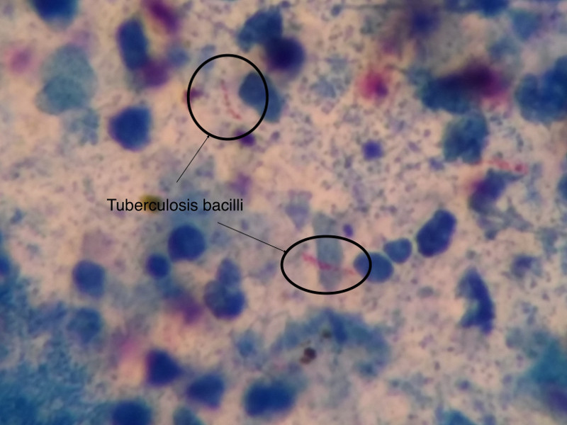 Tuberculosis bacilli