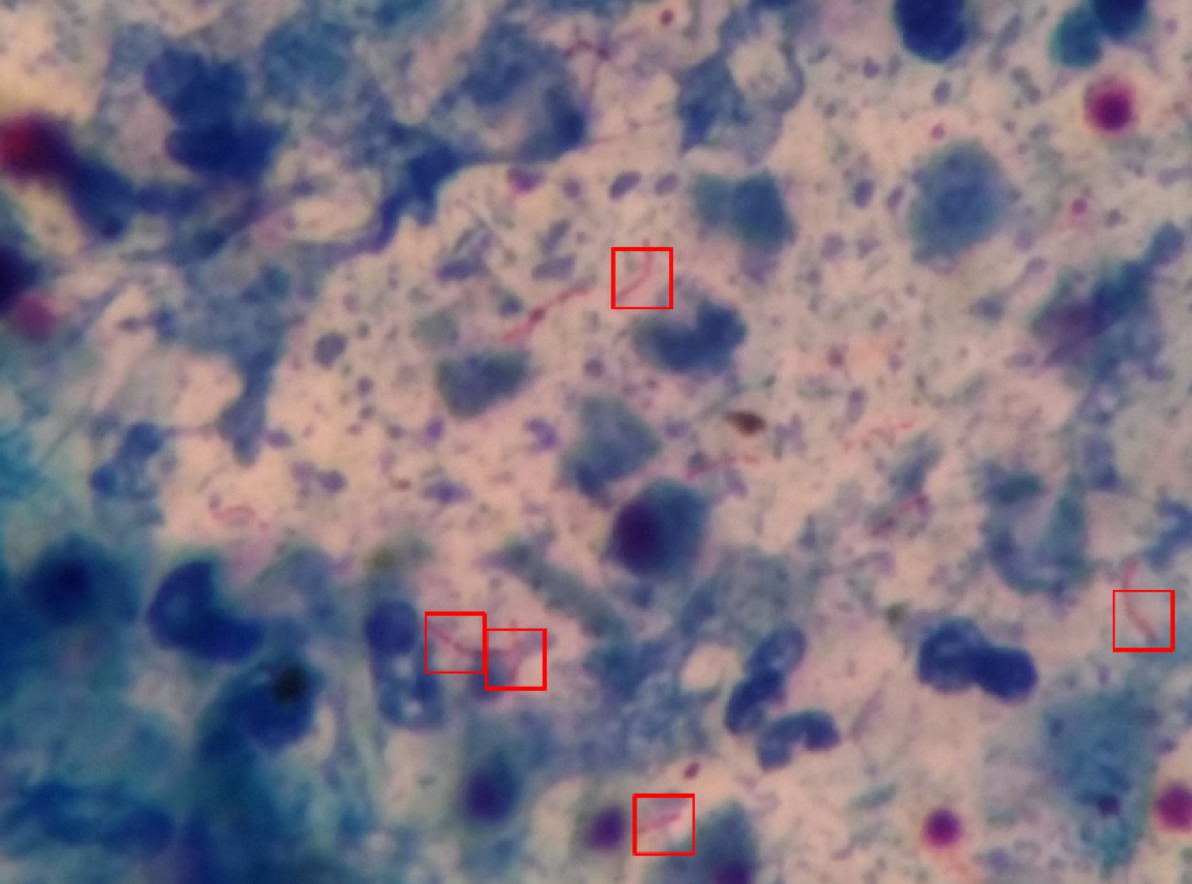 Detection of tuberculosis bacilli